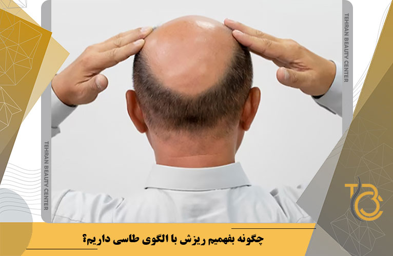 چگونه بفهمیم ریزش با الگوی طاسی داریم؟