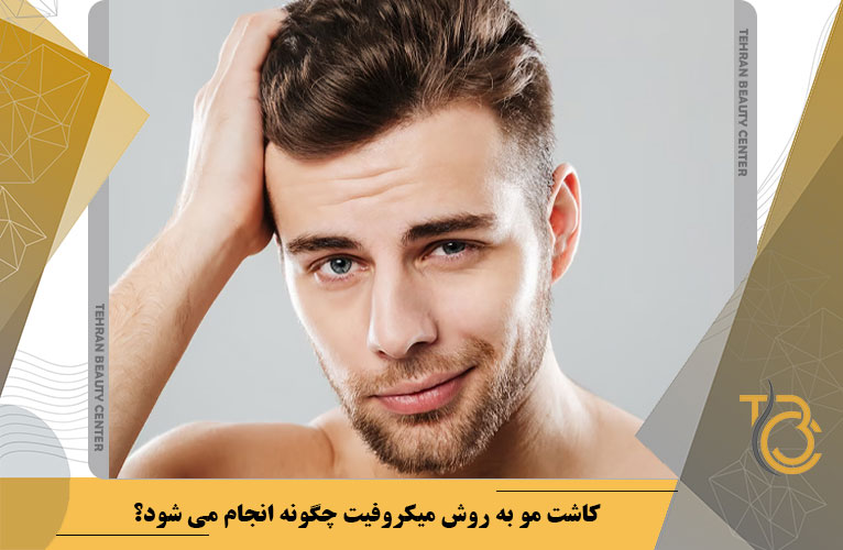 کاشت مو به روش میکروفیت چگونه انجام می شود؟