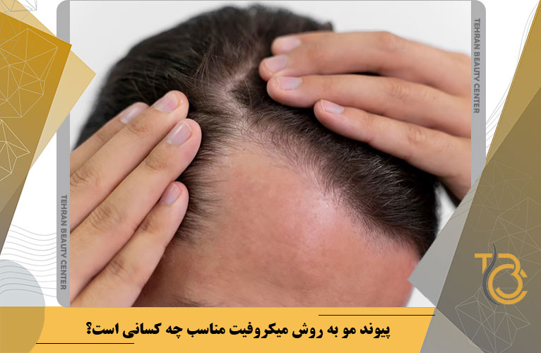 پیوند مو به روش میکروفیت مناسب چه کسانی است؟