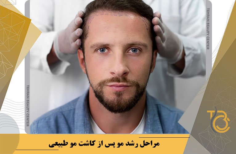 مراحل رشد مو پس از کاشت موی طبیعی