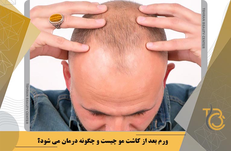 ورم بعد از کاشت مو چیست و چگونه درمان می شود؟