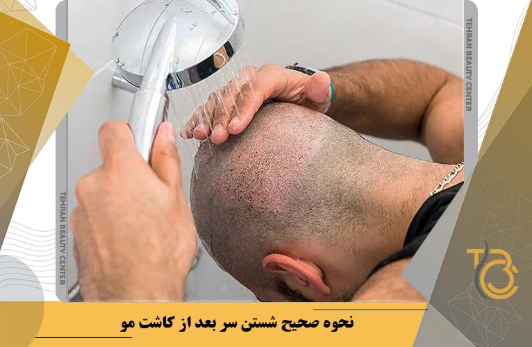 نحوه صحیح شستن سر بعد از کاشت مو