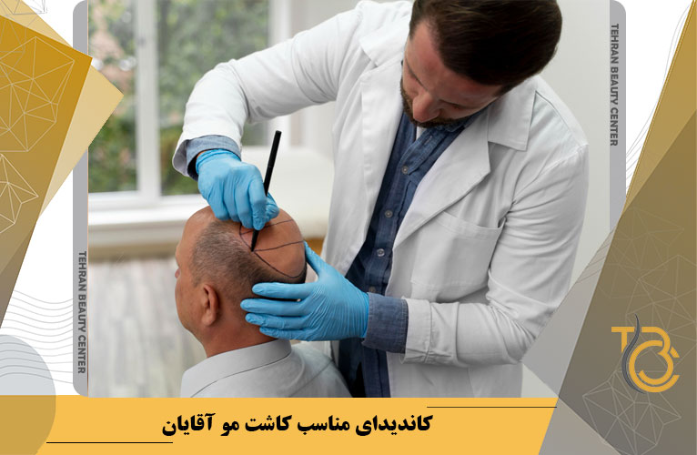 کاندیدای مناسب کاشت مو آقایان