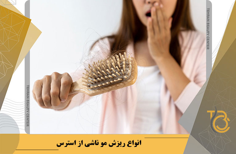 انواع ریزش مو ناشی از استرس