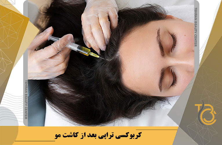 کربوکسی تراپی بعد از کاشت مو