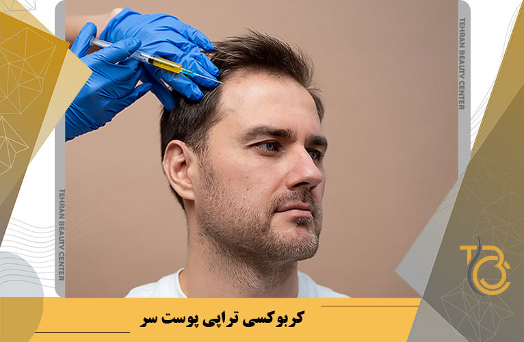 کربوکسی تراپی پوست سر