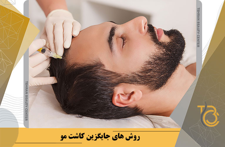 روش های جایگزین کاشت مو