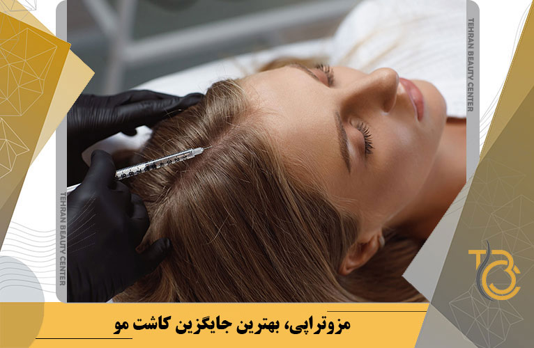 مزوتراپی، بهترین جایگزین کاشت مو