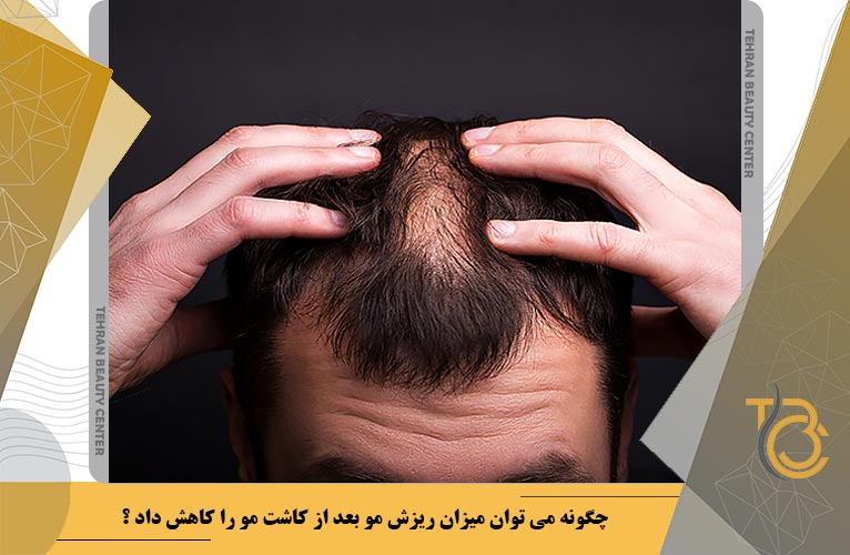 چگونه می توان میزان ریزش مو بعد از کاشت مو را کاهش داد ؟