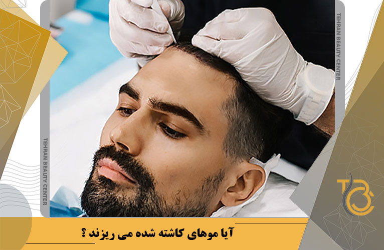 آیا موهای کاشته شده می ریزند؟