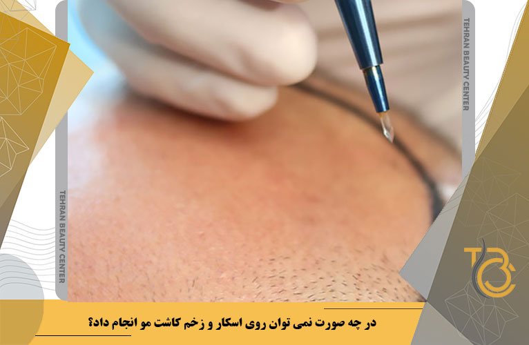 در چه صورت نمی توان روی اسکار کاشت مو انجام داد؟