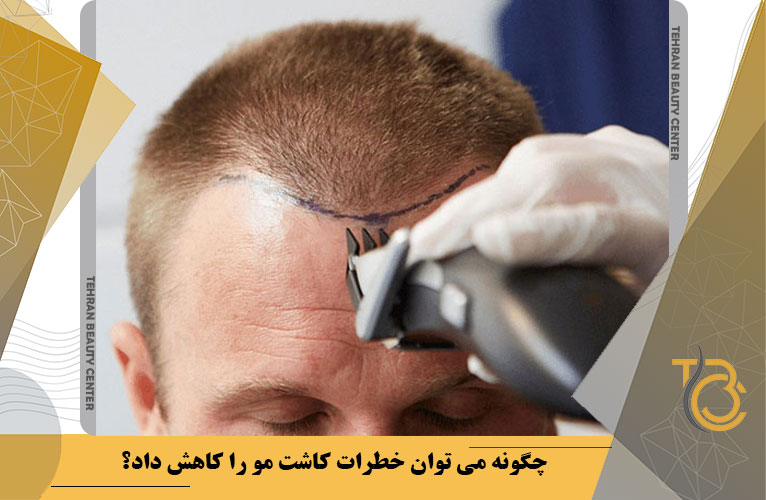 چگونه می توان خطرات کاشت مو را کاهش داد؟