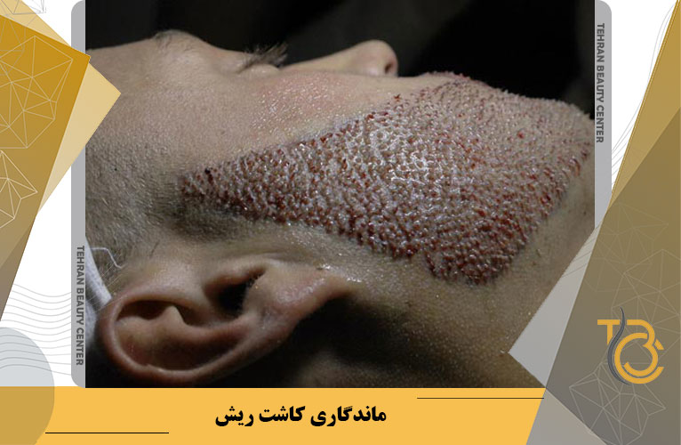 ماندگاری کاشت ریش