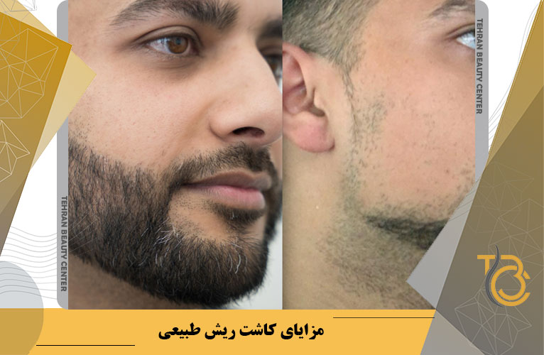 درصد موفقیت کاشت ریش چقدر است؟