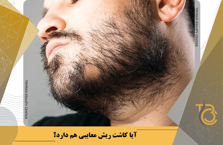 آیا کاشت ریش معایبی هم دارد؟