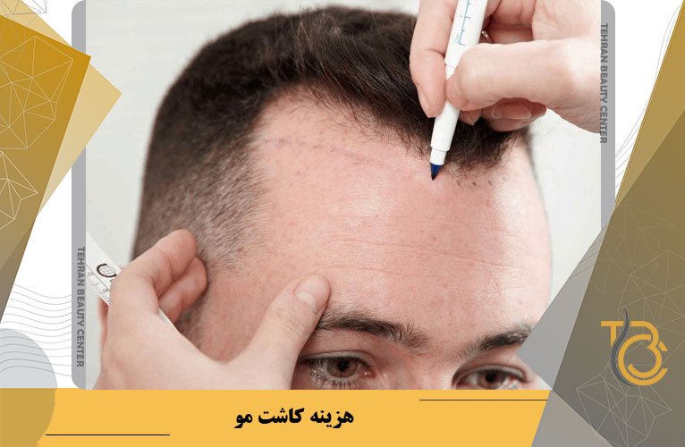 هزینه کاشت مو