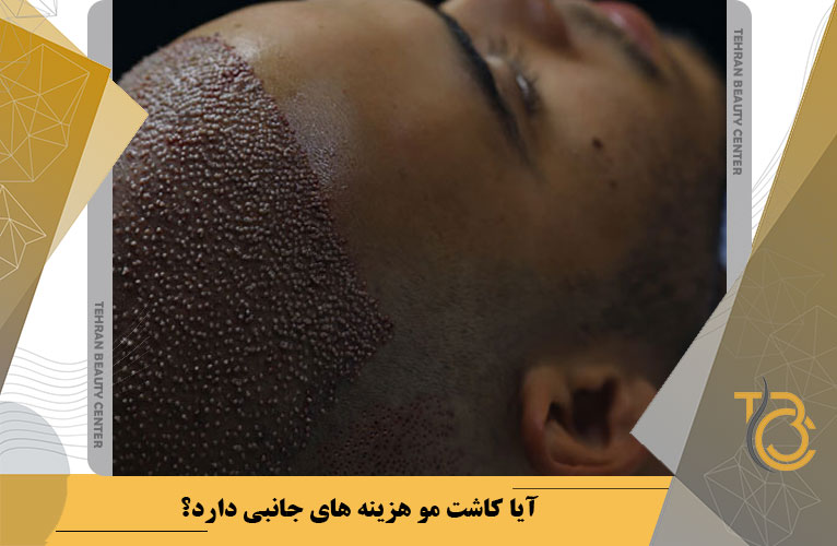 آیا کاشت مو هزینه های جانبی دارد؟