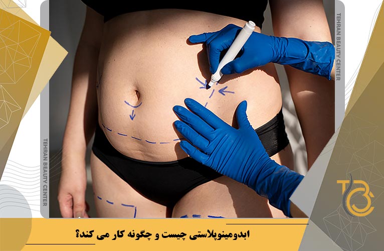 ابدومینوپلاستی چیست و چگونه کار می کند؟