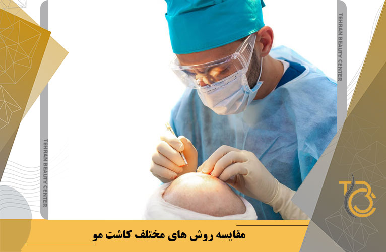 مقایسه روش های مختلف کاشت مو