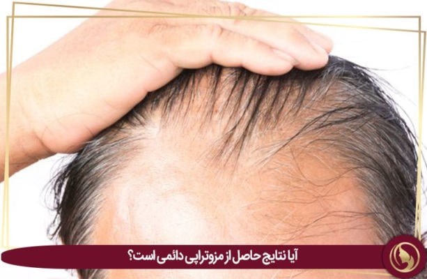 ماندگاری مزوتراپی
