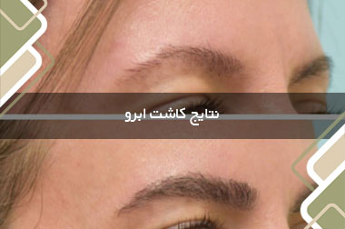 نتایج کاشت ابرو