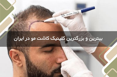بهترین و بزرگترین کلینیک کاشت مو در ایران