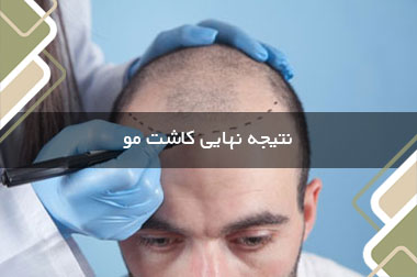 نتیجه نهایی کاشت مو بعد از چند ماه مشخص می شود؟
