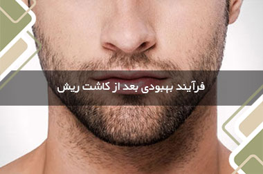فرآیند بهبودی بعد از کاشت ریش