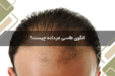 الگوی طاسی مردانه چیست؟