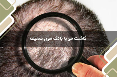 کاشت مو با بانک موی ضعیف