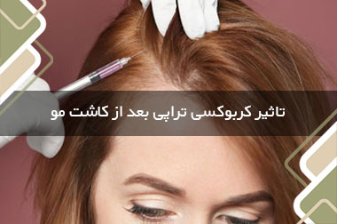 تاثیر کربوکسی تراپی بعد از کاشت مو