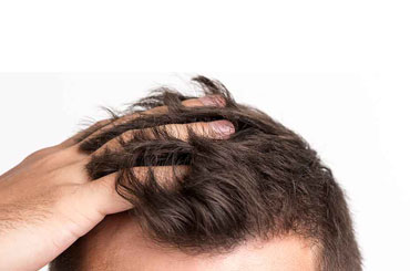 آیا می توان با استفاده از بانک موی دیگران مو کاشت؟