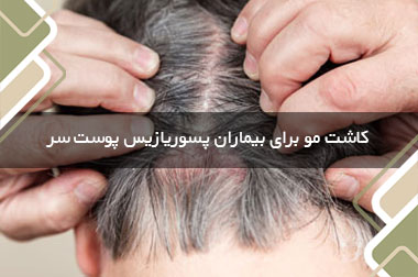 کاشت مو برای بیماران پسوریازیس پوست سر