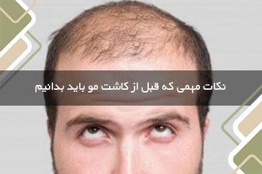 نکات مهمی که قبل از کاشت مو باید بدانیم