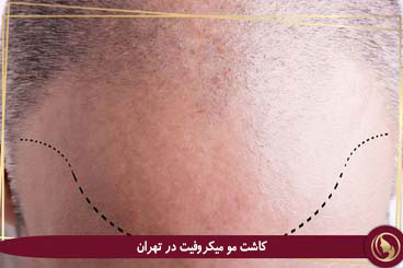 کاشت مو MicroFIT در تهران