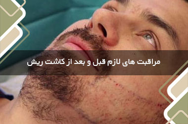 مراقبت های لازم قبل و بعد از کاشت ریش