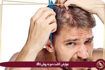 عوارض کاشت مو به روش DHI