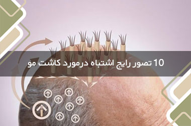 10 تصور رایج اشتباه درمورد کاشت مو