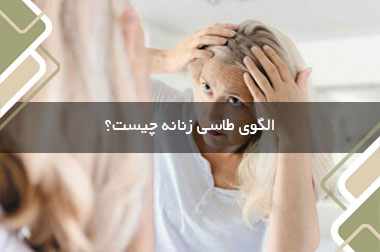 الگوی طاسی زنانه چیست؟