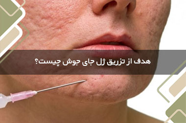هدف از تزریق ژل جای جوش چیست؟