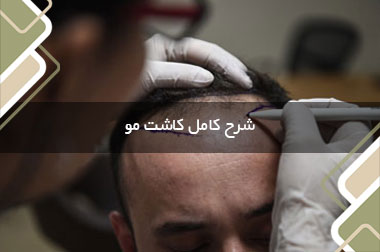 شرح کامل کاشت مو