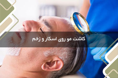 کاشت مو روی اسکار و زخم