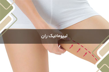 لیپوماتیک ران