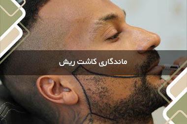 ماندگاری کاشت ریش