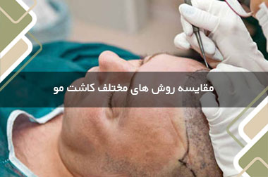 مقایسه روش های مختلف کاشت مو