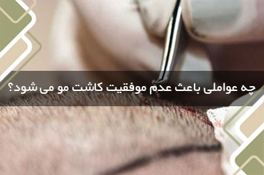 چه عواملی باعث عدم موفقیت کاشت مو می شود؟