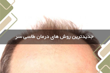جدیدترین روش های درمان طاسی سر