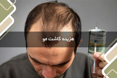 هزینه کاشت مو