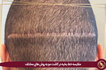 مقایسه خط بخیه در کاشت مو به روش های مختلف