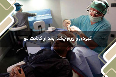 کبودی و ورم چشم بعد از کاشت مو